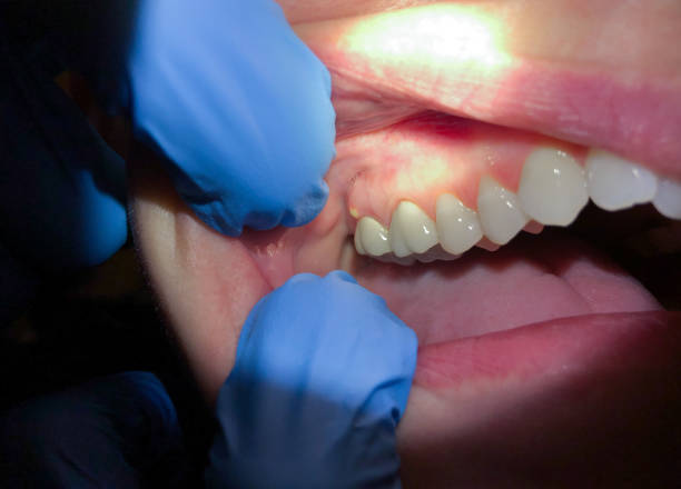 Best Knocked-Out Tooth Emergency  in Clear Lake Shores, TX